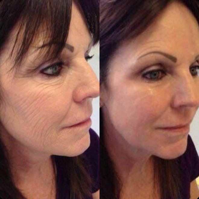 Éternité Spa client before and after the LED Facelift Facial