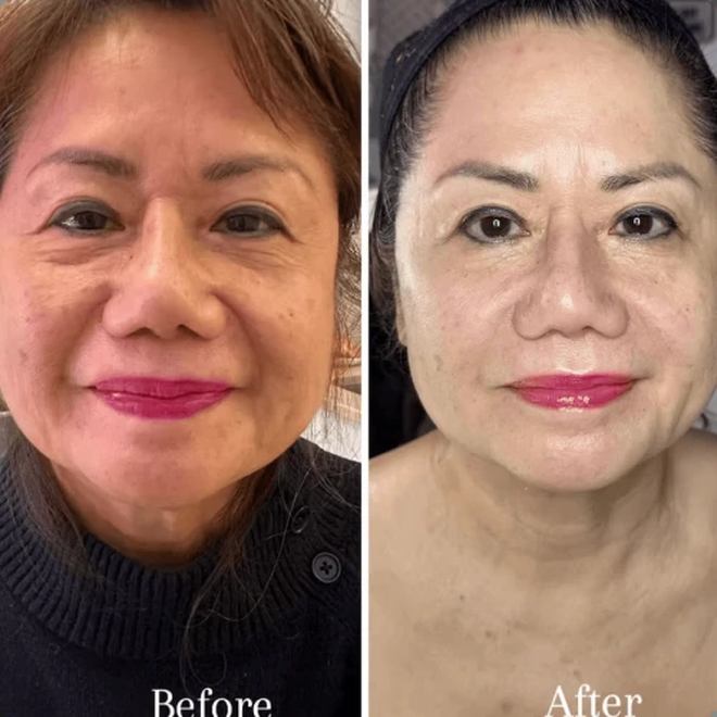 Éternité Spa client before and after a course of treatments