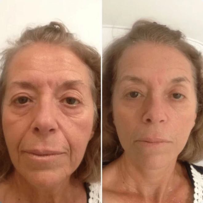 Éternité Spa client before and after a course of treatments