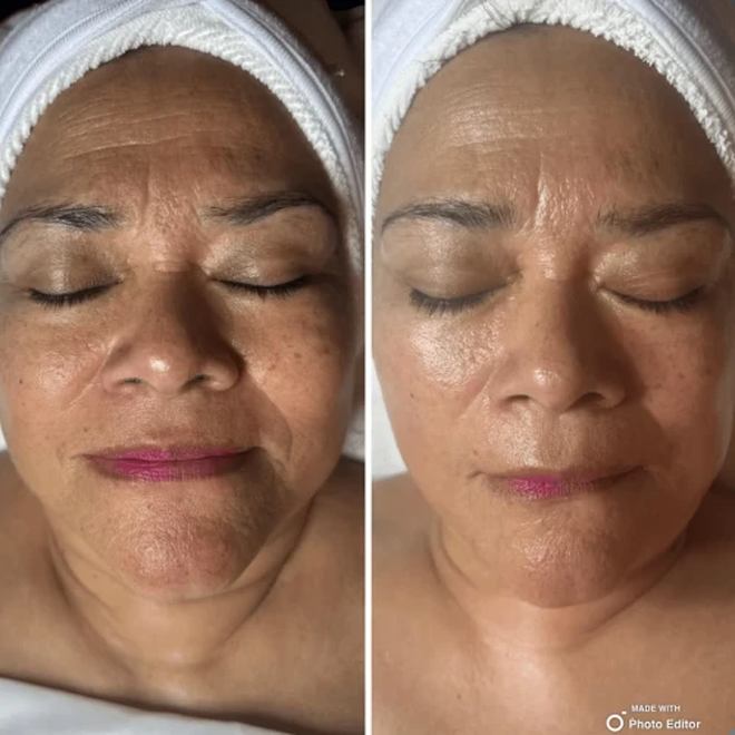 Éternité Spa client before and after a course of treatments