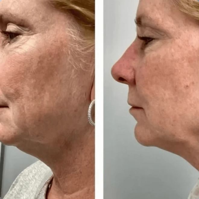 Éternité Spa client before and after the LED Facelift Facial