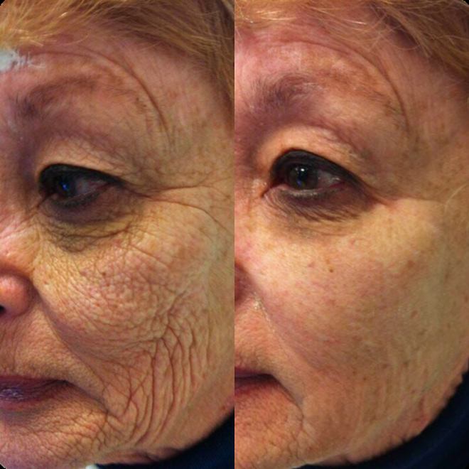 Éternité Spa client before and after the LED Facelift Facial