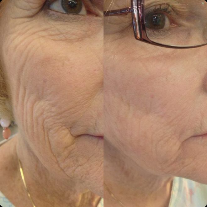 Éternité Spa client before and after the LED Facelift Facial