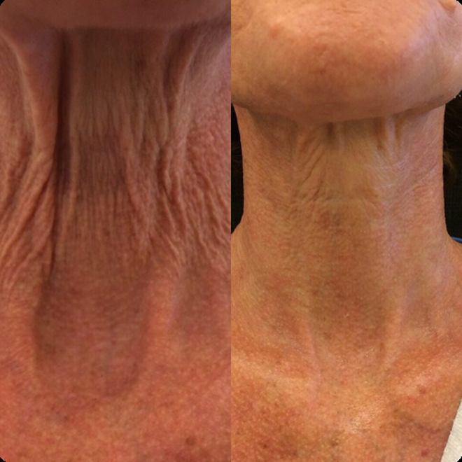 Éternité Spa client before and after the LED Facelift Facial