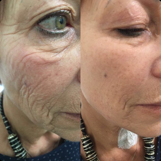 Éternité Spa client before and after the LED Facelift Facial